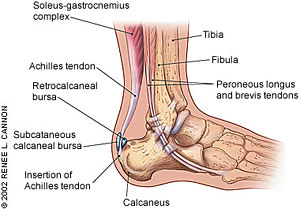 Steroid injection to treat plantar fasciitis